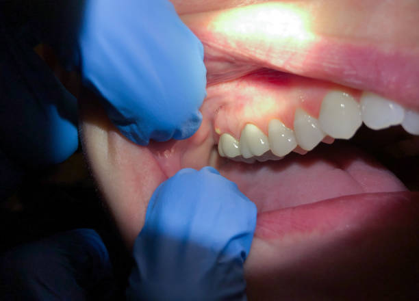 Best Broken or Cracked Tooth Emergency Dentist in Sebewaing, MI